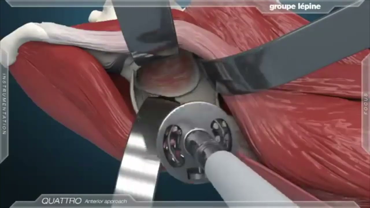 Prothèse totale de hanche PTH - Chirurgie arthrose voie antérieure mini-invasive - Dr Tournemine